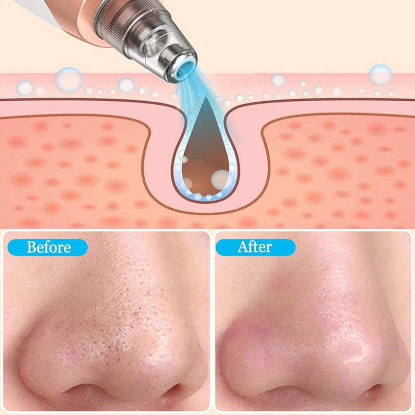 میکرودرم پاکسازی صورت 6851 - Image 4